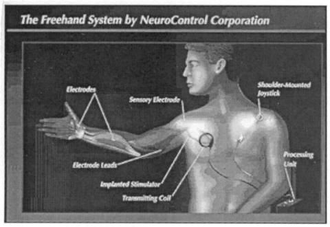 Neurocontrol Freehand System